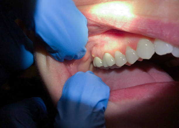 Best Emergency Tooth Extraction in Alamo Heights, TX